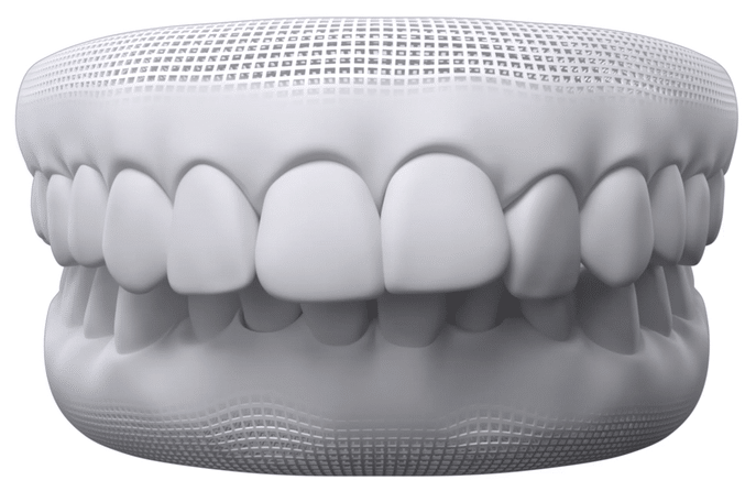 Deep Bite and Increased Overjet Deep Bite and Increased Overjet